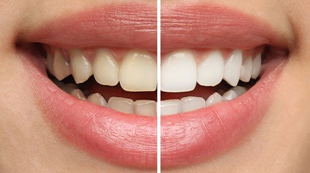 Closeup of a smile that’s half-whitened to show before/after results