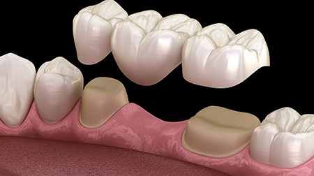 Illustration of traditional dental bridge being placed on teeth