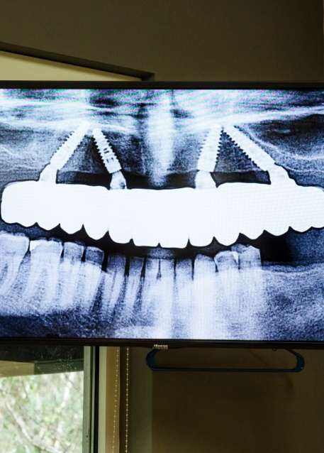 Dentist pointing to computer screen showing x ray of teeth