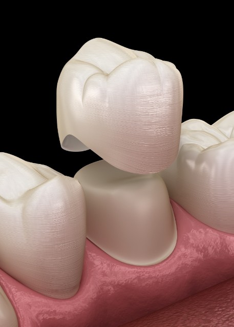 Illustrated dental crown being fitted over a tooth