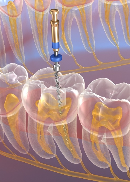 Illustrated dental tool cleaning inside of tooth during root canal treatment