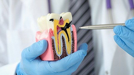 Gloved hands holding model of damaged tooth requiring root canal