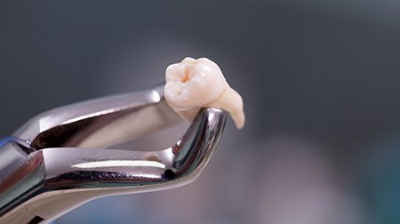 Extracted tooth held by forceps