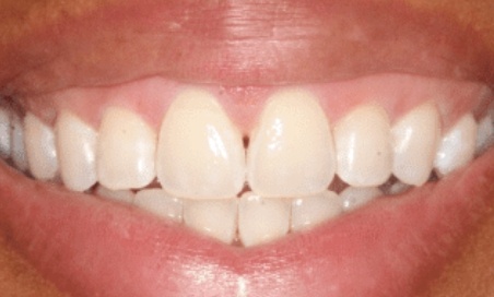 Mouth with even row of lower teeth