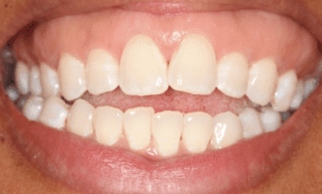 Mouth with open bite