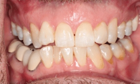 Mouth with crooked lower teeth