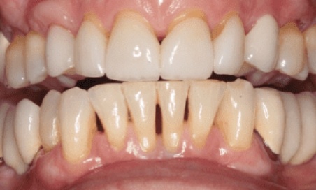 Mouth with gapped teeth