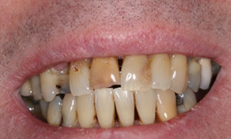 Mouth with several discolored and gapped teeth