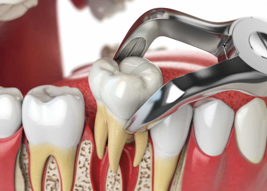 3D image of a tooth extraction