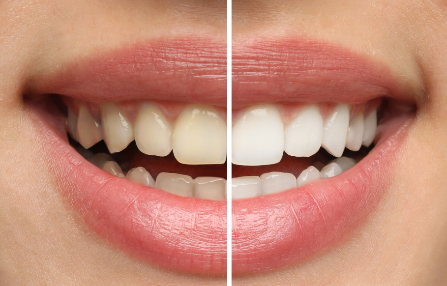 Close up of smile before and after whitening